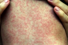 ALERTA VERMELHO – Sarampo volta a ameaçar e baixa cobertura vacinal preocupa